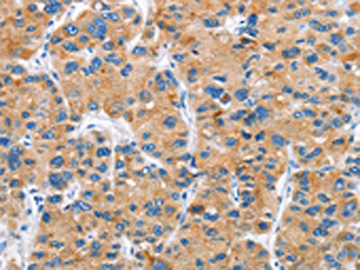 The image on the left is immunohistochemistry of paraffin-embedded Human liver cancer tissue using CSB-PA694579(DKK2 Antibody) at dilution 1/60, on the right is treated with fusion protein. (Original magnification: ×200)
