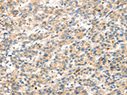 The image on the left is immunohistochemistry of paraffin-embedded Human liver cancer tissue using CSB-PA694660(DKK1 Antibody) at dilution 1/35, on the right is treated with synthetic peptide. (Original magnification: ×200)