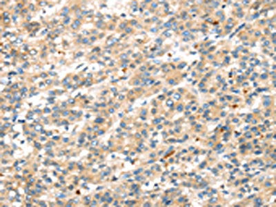 The image on the left is immunohistochemistry of paraffin-embedded Human liver cancer tissue using CSB-PA694660(DKK1 Antibody) at dilution 1/35, on the right is treated with synthetic peptide. (Original magnification: ×200)
