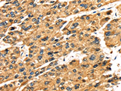 The image on the left is immunohistochemistry of paraffin-embedded Human liver cancer tissue using CSB-PA694728(SLC25A26 Antibody) at dilution 1/30, on the right is treated with fusion protein. (Original magnification: ×200)
