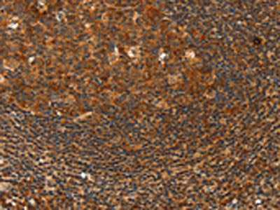 The image on the left is immunohistochemistry of paraffin-embedded Human tonsil tissue using CSB-PA694837(HDAC8 Antibody) at dilution 1/40, on the right is treated with fusion protein. (Original magnification: ×200)