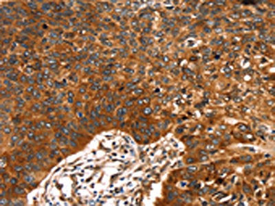 The image on the left is immunohistochemistry of paraffin-embedded Human esophagus cancer tissue using CSB-PA694879(RUNX2 Antibody) at dilution 1/20, on the right is treated with synthetic peptide. (Original magnification: ×200)