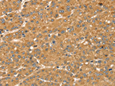 The image on the left is immunohistochemistry of paraffin-embedded Human liver cancer tissue using CSB-PA695003(SNX2 Antibody) at dilution 1/40, on the right is treated with synthetic peptide. (Original magnification: ×200)