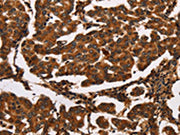 The image on the left is immunohistochemistry of paraffin-embedded Human breast cancer tissue using CSB-PA695075(ARSB Antibody) at dilution 1/50, on the right is treated with synthetic peptide. (Original magnification: ×200)