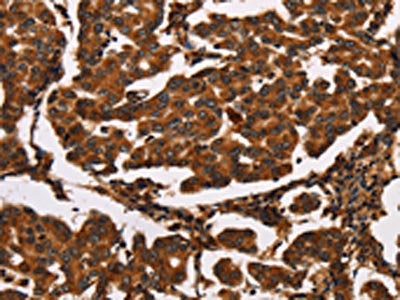 The image on the left is immunohistochemistry of paraffin-embedded Human breast cancer tissue using CSB-PA695075(ARSB Antibody) at dilution 1/50, on the right is treated with synthetic peptide. (Original magnification: ×200)