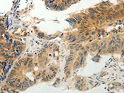 The image on the left is immunohistochemistry of paraffin-embedded Human colon cancer tissue using CSB-PA695128(CMTM7 Antibody) at dilution 1/30, on the right is treated with synthetic peptide. (Original magnification: X200)