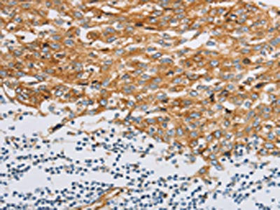 The image on the left is immunohistochemistry of paraffin-embedded Human esophagus cancer tissue using CSB-PA695151(IFITM3 Antibody) at dilution 1/20, on the right is treated with fusion protein. (Original magnification: ×200)