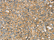 The image on the left is immunohistochemistry of paraffin-embedded Human breast cancer tissue using CSB-PA695180(STX11 Antibody) at dilution 1/30, on the right is treated with fusion protein. (Original magnification: ×200)