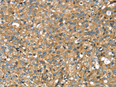 The image on the left is immunohistochemistry of paraffin-embedded Human breast cancer tissue using CSB-PA695180(STX11 Antibody) at dilution 1/30, on the right is treated with fusion protein. (Original magnification: ×200)