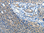 The image on the left is immunohistochemistry of paraffin-embedded Human cervical cancer tissue using CSB-PA695367(ATP1A1 Antibody) at dilution 1/35, on the right is treated with synthetic peptide. (Original magnification: ×200)