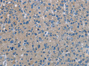 The image on the left is immunohistochemistry of paraffin-embedded Human liver cancer tissue using CSB-PA695381(PHKA1 Antibody) at dilution 1/40, on the right is treated with synthetic peptide. (Original magnification: ×200)