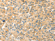 The image on the left is immunohistochemistry of paraffin-embedded Human liver cancer tissue using CSB-PA695474(SAMD7 Antibody) at dilution 1/20, on the right is treated with fusion protein. (Original magnification: ×200)