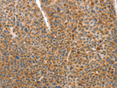 The image on the left is immunohistochemistry of paraffin-embedded Human liver cancer tissue using CSB-PA695560(DDX58 Antibody) at dilution 1/70, on the right is treated with synthetic peptide. (Original magnification: ×200)