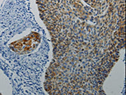 The image on the left is immunohistochemistry of paraffin-embedded Human cervical cancer tissue using CSB-PA695604(DRD4 Antibody) at dilution 1/5, on the right is treated with synthetic peptide. (Original magnification: ×200)