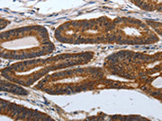 The image on the left is immunohistochemistry of paraffin-embedded Human colon cancer tissue using CSB-PA695661(PDCD7 Antibody) at dilution 1/60, on the right is treated with synthetic peptide. (Original magnification: ×200)