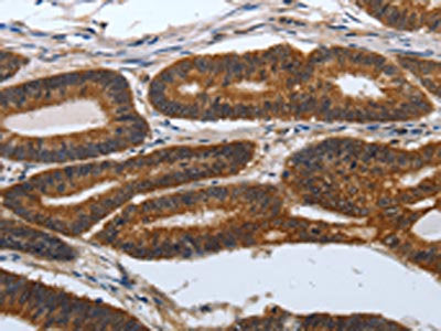 The image on the left is immunohistochemistry of paraffin-embedded Human colon cancer tissue using CSB-PA695661(PDCD7 Antibody) at dilution 1/60, on the right is treated with synthetic peptide. (Original magnification: ×200)