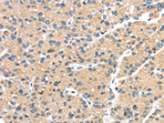 The image on the left is immunohistochemistry of paraffin-embedded Human liver cancer tissue using CSB-PA696035(GPD2 Antibody) at dilution 1/20, on the right is treated with synthetic peptide. (Original magnification: ×200)