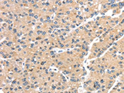 The image on the left is immunohistochemistry of paraffin-embedded Human liver cancer tissue using CSB-PA696035(GPD2 Antibody) at dilution 1/20, on the right is treated with synthetic peptide. (Original magnification: ×200)