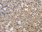 The image on the left is immunohistochemistry of paraffin-embedded Human thyroid cancer tissue using CSB-PA696333(DRG1 Antibody) at dilution 1/30, on the right is treated with fusion protein. (Original magnification: ×200)