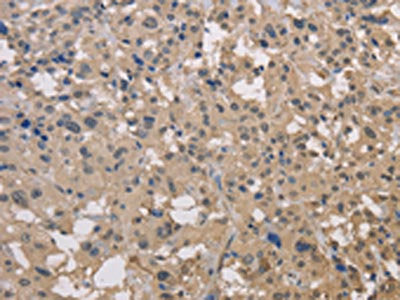 The image on the left is immunohistochemistry of paraffin-embedded Human thyroid cancer tissue using CSB-PA696333(DRG1 Antibody) at dilution 1/30, on the right is treated with fusion protein. (Original magnification: ×200)