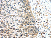 The image on the left is immunohistochemistry of paraffin-embedded Human esophagus cancer tissue using CSB-PA696394(TSPY1/TSPY3 Antibody) at dilution 1/45, on the right is treated with synthetic peptide. (Original magnification: ×200)