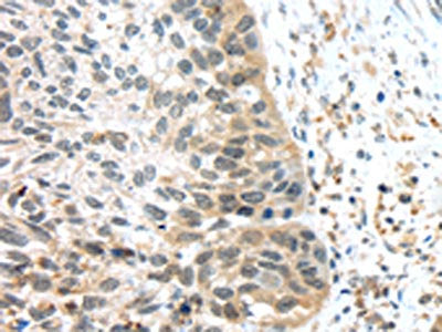 The image on the left is immunohistochemistry of paraffin-embedded Human esophagus cancer tissue using CSB-PA696394(TSPY1/TSPY3 Antibody) at dilution 1/45, on the right is treated with synthetic peptide. (Original magnification: ×200)
