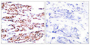 Immunohistochemical analysis of paraffin-embedded human breast carcinoma tissue using JunB(Phospho-Ser79) Antibody(left) or the same antibody preincubated with blocking peptide(right).