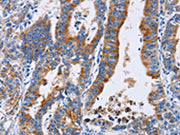 The image on the left is immunohistochemistry of paraffin-embedded Human gastic cancer tissue using CSB-PA696568(ANXA4 Antibody) at dilution 1/25, on the right is treated with fusion protein. (Original magnification: ×200)