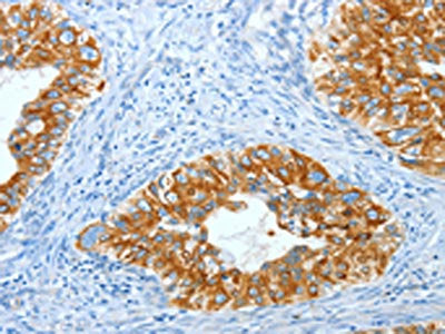 The image on the left is immunohistochemistry of paraffin-embedded Human cervical cancer tissue using CSB-PA696577(KRT40 Antibody) at dilution 1/30, on the right is treated with fusion protein. (Original magnification: ×200)