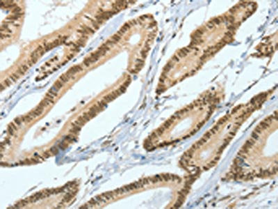 The image on the left is immunohistochemistry of paraffin-embedded Human colon cancer tissue using CSB-PA696621(ASH2L Antibody) at dilution 1/50, on the right is treated with fusion protein. (Original magnification: ×200)