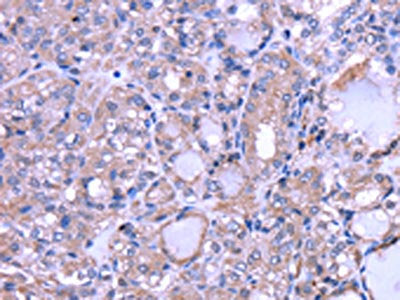 The image on the left is immunohistochemistry of paraffin-embedded Human thyroid cancer tissue using CSB-PA696718(THRSP Antibody) at dilution 1/30, on the right is treated with fusion protein. (Original magnification: ×200)