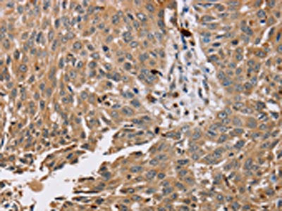 The image on the left is immunohistochemistry of paraffin-embedded Human lung cancer tissue using CSB-PA697080(PDLIM7 Antibody) at dilution 1/35, on the right is treated with fusion protein. (Original magnification: ×200)