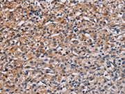 The image on the left is immunohistochemistry of paraffin-embedded Human prostate cancer tissue using CSB-PA697082(PLCB3 Antibody) at dilution 1/40, on the right is treated with synthetic peptide. (Original magnification: ×200)