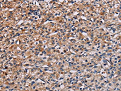 The image on the left is immunohistochemistry of paraffin-embedded Human prostate cancer tissue using CSB-PA697082(PLCB3 Antibody) at dilution 1/40, on the right is treated with synthetic peptide. (Original magnification: ×200)