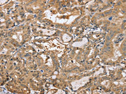 The image on the left is immunohistochemistry of paraffin-embedded Human thyroid cancer tissue using CSB-PA697255(PPP2R3A Antibody) at dilution 1/30, on the right is treated with synthetic peptide. (Original magnification: ×200)