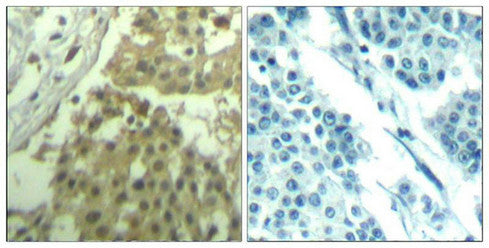 Immunohistochemical analysis of paraffin-embedded human breast carcinoma tissue using CDC2(Ab-19) Antibody(left) or the same antibody preincubated with blocking peptide(right).