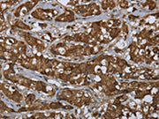 The image on the left is immunohistochemistry of paraffin-embedded Human breast cancer tissue using CSB-PA697513(PIP Antibody) at dilution 1/50, on the right is treated with fusion protein. (Original magnification: ×200)
