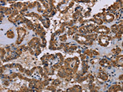 The image on the left is immunohistochemistry of paraffin-embedded Human thyroid cancer tissue using CSB-PA697554(GRK1 Antibody) at dilution 1/40, on the right is treated with synthetic peptide. (Original magnification: ×200)