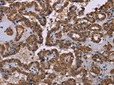 The image on the left is immunohistochemistry of paraffin-embedded Human thyroid cancer tissue using CSB-PA697554(GRK1 Antibody) at dilution 1/40, on the right is treated with synthetic peptide. (Original magnification: ×200)