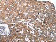 The image on the left is immunohistochemistry of paraffin-embedded Human breast cancer tissue using CSB-PA697594(NQO2 Antibody) at dilution 1/50, on the right is treated with synthetic peptide. (Original magnification: ×200)