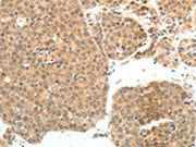 The image on the left is immunohistochemistry of paraffin-embedded Human ovarian cancer tissue using CSB-PA697643(PSMD7 Antibody) at dilution 1/20, on the right is treated with fusion protein. (Original magnification: ×200)