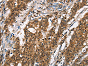 The image on the left is immunohistochemistry of paraffin-embedded Human gastic cancer tissue using CSB-PA697671(BCAS4 Antibody) at dilution 1/50, on the right is treated with synthetic peptide. (Original magnification: ×200)