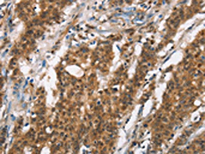 The image on the left is immunohistochemistry of paraffin-embedded Human gastic cancer tissue using CSB-PA697671(BCAS4 Antibody) at dilution 1/50, on the right is treated with synthetic peptide. (Original magnification: ×200)