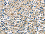 The image on the left is immunohistochemistry of paraffin-embedded Human liver cancer tissue using CSB-PA697715(TRAIP Antibody) at dilution 1/40, on the right is treated with fusion protein. (Original magnification: ×200)