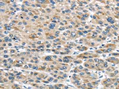 The image on the left is immunohistochemistry of paraffin-embedded Human liver cancer tissue using CSB-PA697715(TRAIP Antibody) at dilution 1/40, on the right is treated with fusion protein. (Original magnification: ×200)