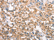 The image on the left is immunohistochemistry of paraffin-embedded Human thyroid cancer tissue using CSB-PA697830(LATS2 Antibody) at dilution 1/30, on the right is treated with synthetic peptide. (Original magnification: ×200)
