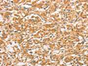 The image on the left is immunohistochemistry of paraffin-embedded Human thyroid cancer tissue using CSB-PA697913(TLR3 Antibody) at dilution 1/50, on the right is treated with fusion protein. (Original magnification: ×200)