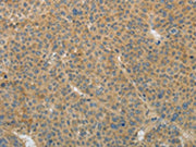 The image on the left is immunohistochemistry of paraffin-embedded Human liver cancer tissue using CSB-PA697937(TGFB1 Antibody) at dilution 1/25, on the right is treated with fusion protein. (Original magnification: X200)