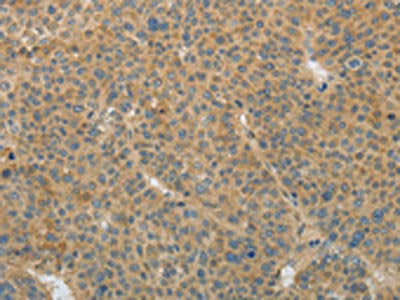 The image on the left is immunohistochemistry of paraffin-embedded Human liver cancer tissue using CSB-PA697937(TGFB1 Antibody) at dilution 1/25, on the right is treated with fusion protein. (Original magnification: X200)