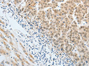 The image on the left is immunohistochemistry of paraffin-embedded Human liver cancer tissue using CSB-PA697958(AKAP8L Antibody) at dilution 1/20, on the right is treated with synthetic peptide. (Original magnification: ×200)